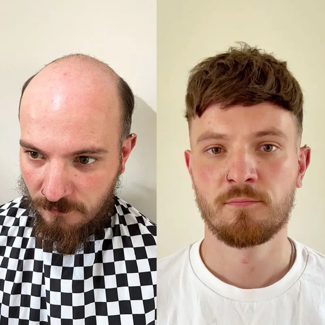 HS27P : Fine Mono Hairpiece With Skin Gauze Perimeter and Lace Front (120% Density)